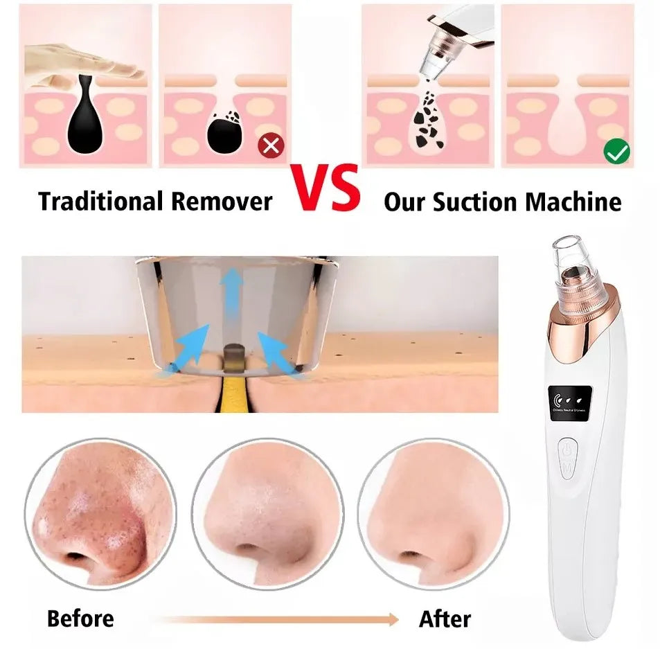 Rechargeable Blackhead Remover Machine